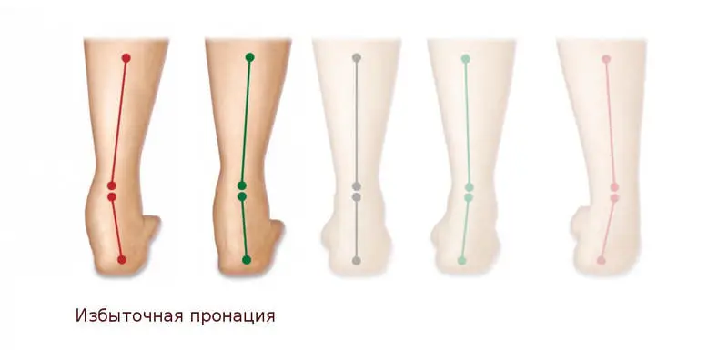 Недостаточная пронация стопы (разворот стопы внутрь) Недостаточная пронация стопы (разворот стопы внутрь)